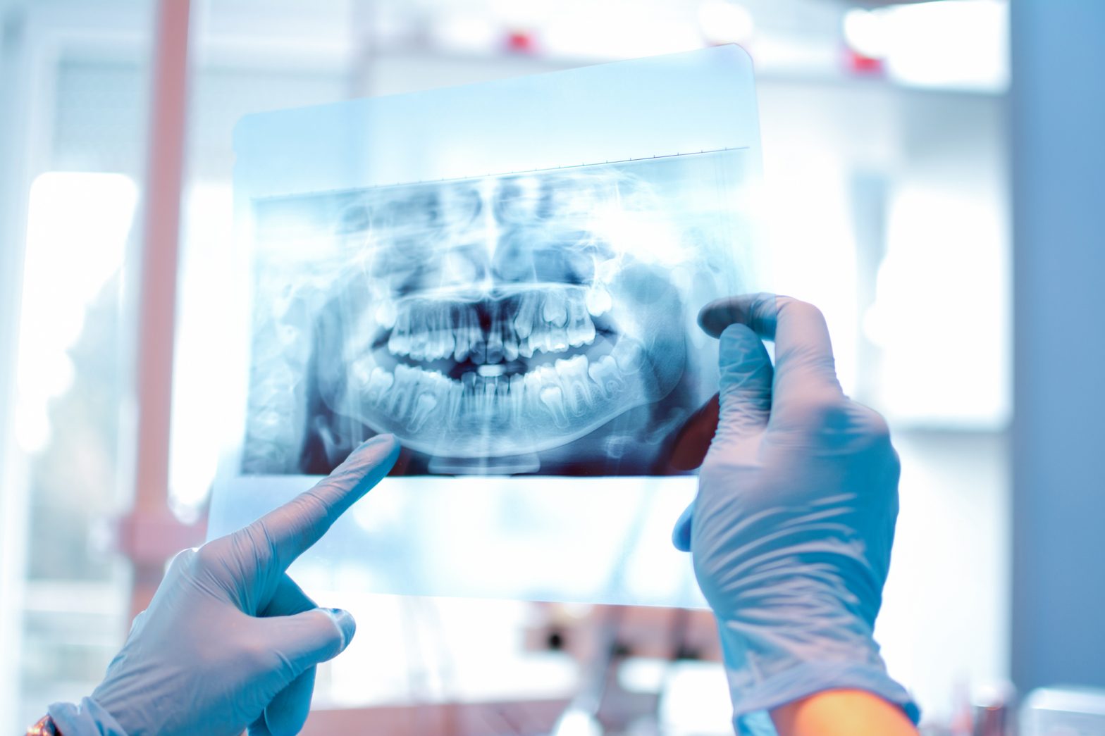 pérdida hueso dental