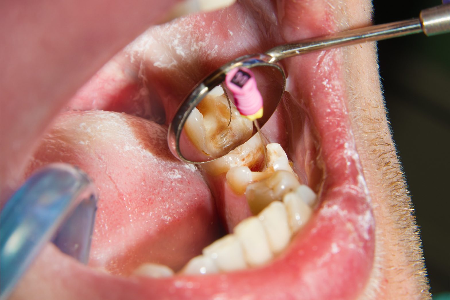 importante endodoncia